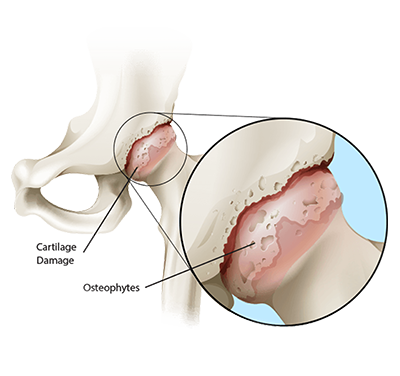 人工股関節置換術を理解する 03 02 Hip Arthritic 1