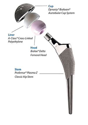 人工股関節置換術を理解する 03 04 Hip Example 1