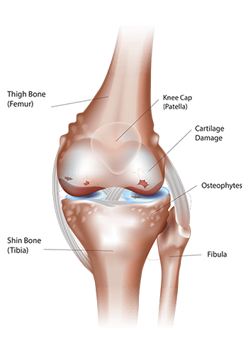 人工膝関節置換術を理解する 03 52 Knee Arthritis 1