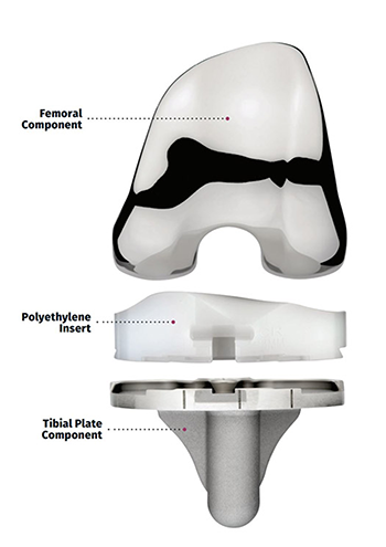 人工膝関節置換術を理解する 03 54 Knee Implant Close 1
