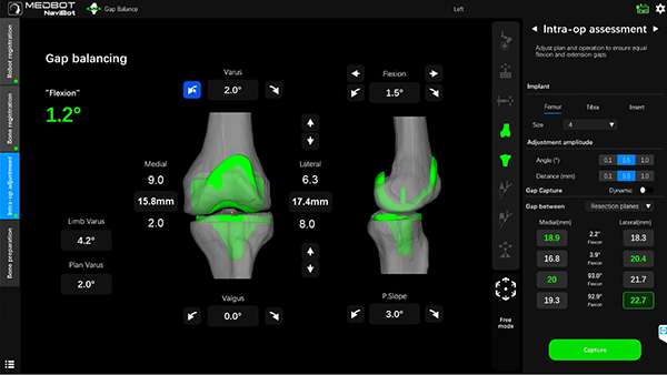 SkyWalker® Intra Op Adjustments Gap Balancing 1